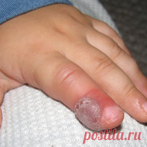 Народные средства лечения нарыва на пальце.