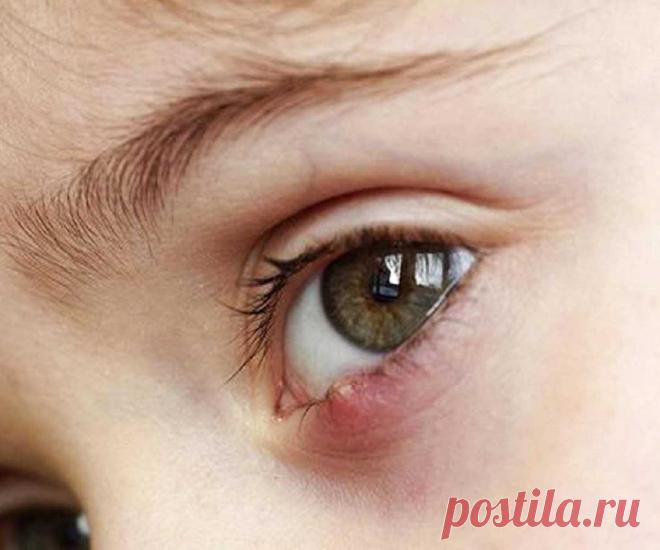 Какой есть заговор от ячменя? 100% Заговоры и заклинания