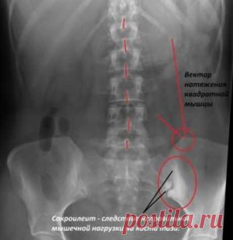 Сакроилеит - причины развития, симптомы, лечение и возможные последствия