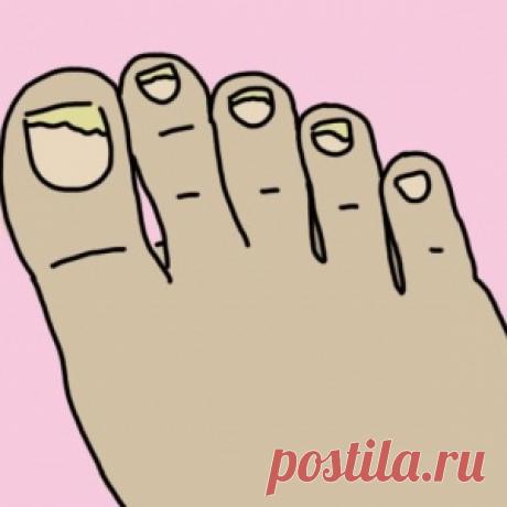 Она подержала ноги в ополаскивателе для рта 30 минут. То, что случилось потом, напоминает чудо!