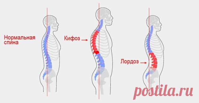 Гиперлордоз: полное руководство по лечению, упражнениям и профилактике | NobleRise — крупнейший в России производитель EMS-оборудования | Дзен