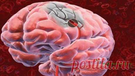 Инсульт - его признаки и причины. - 25 Марта 2015 - Для пользы тела!