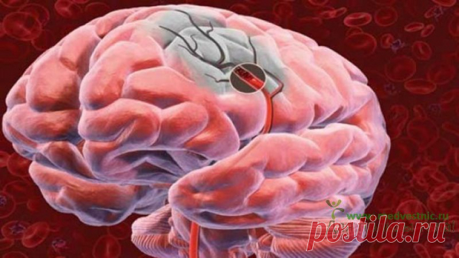 Инсульт - его признаки и причины. - 25 Марта 2015 - Для пользы тела!