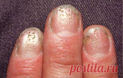 Псориаз ногтей, лечение, симптомы, фото