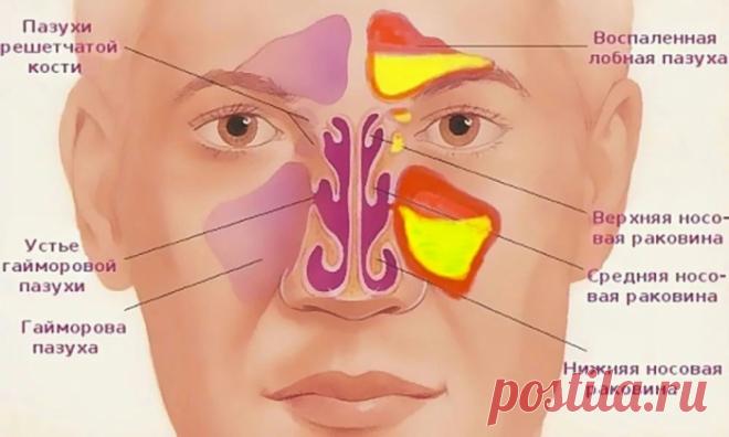 КАК ОЧИСТИТЬ ГАЙМОРОВЫЕ И ЛОБНЫЕ ПАЗУХИ ОТ ГНОЯ И СЛИЗИ