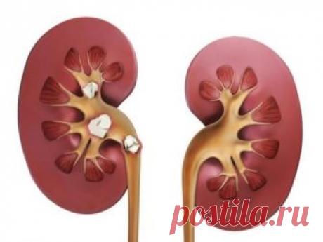 Почему появляются камни в почках Многие люди страдают от того что в почках накапливаются камни. Этот процесс можно предотвратить и вылечить, если использовать методы из народной медицины. Почему появляются камни в почках и как от них избавиться, рассмотрим в сегодняшней статье...