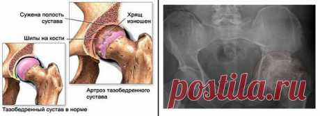 Профилактика и лечение остеохондроза.
