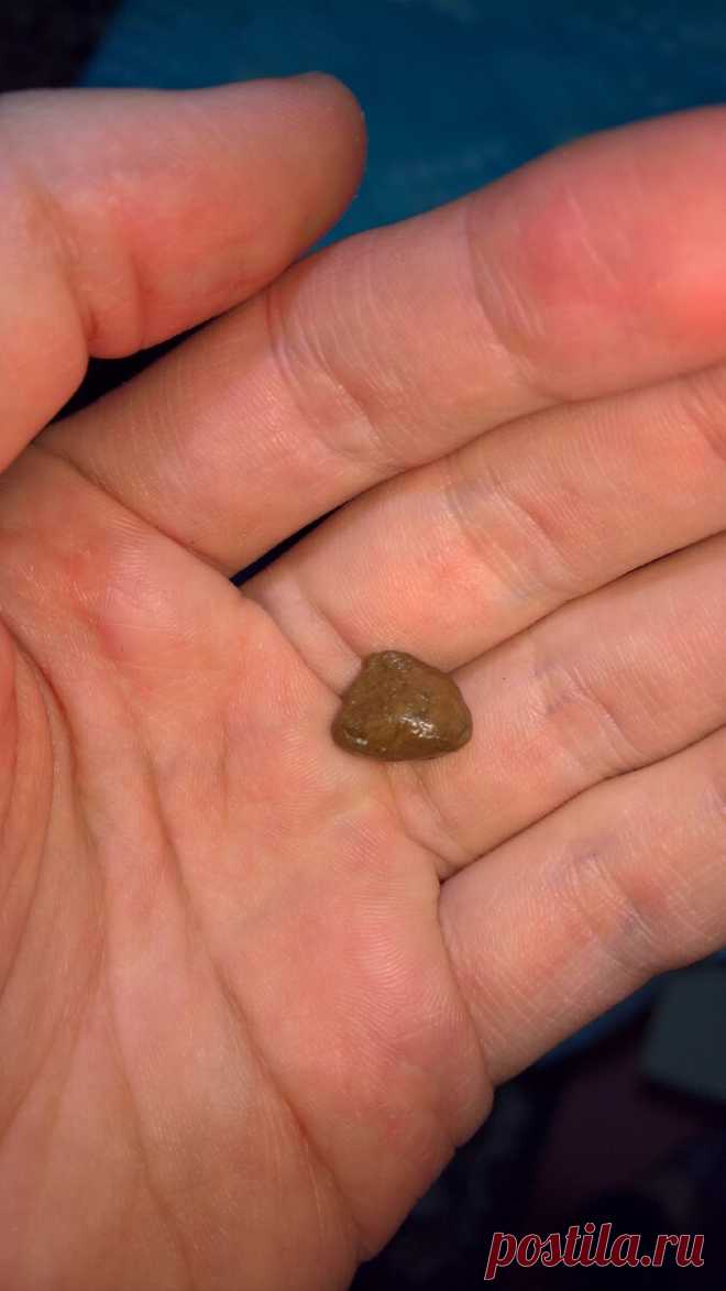 Как я избавился от болей в поджелудочной и панкреатита с помощью прополиса. Рецепт без использования спирта | Дневник здоровья | Яндекс Дзен