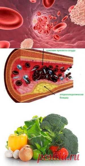Атеросклероз: симптомы и профилактика / Будьте здоровы