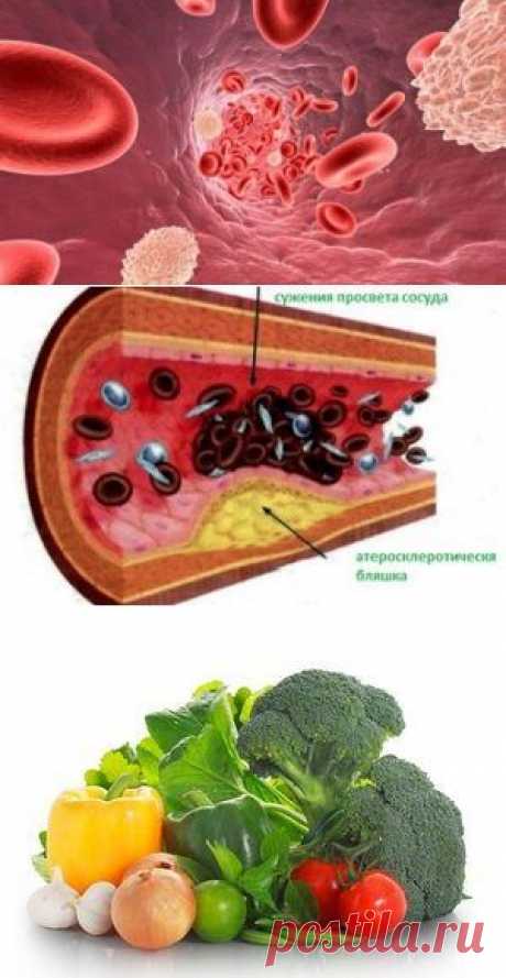 Атеросклероз: симптомы и профилактика / Будьте здоровы