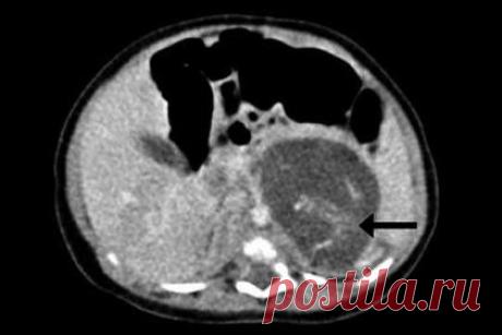 В момент рождения гонконгская девочка оказалось беременной двумя братьями. О развитии и причинах этого редчайшего синдрома сообщает Live Science.

Случаи эмбриона в эмбрионе происходят в среднем один раз на полмиллиона беременностей. О причинах этого явления врачи и ученые спорят. Всемирная организация здравоохранения считает плод внутри новорожденного младенца тератомой (вид опухоли), но гонконгские врачи утверждают, что у их пациентки в организме нашлись