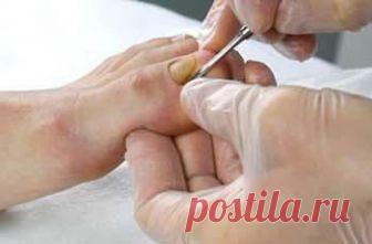 Грибок ногтей на ногах, причины, симптомы, лечение, профилактика : Болезни Проблема грибкового поражения ногтевой пластины на ногах сегодня знакома каждому десятому жителю планеты. Заболевание не доставляет нам никаких неудобств, кроме эстетических, важно своевременно заняться его лечением, и не пускать дело на самотек, поскольку в процессе размножения на ногтях грибки выделяют токсины, которые, при попадании в кровь, начинают отравлять наш организм и угнетать иммунную систему.