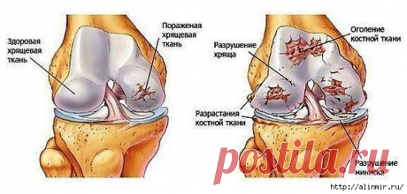 Чудо рецепт от боли в суставах!