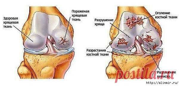 Чудо рецепт от боли в суставах!