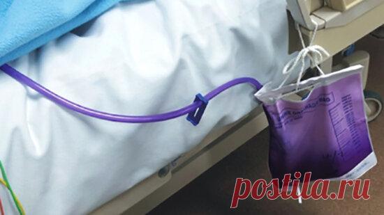 Может ли моча быть фиолетовой и нормально ли это?
Цвет мочи – это важный показатель здоровья не только почек и мочевыделительной системы, но и всего организма в целом. У здоровых людей в зависимости от объем потребляемой жидкости и температуры окружающей среды, потоотделения, моча имеет цвет от бледно-желтого, до янтарного, соломенного. Некоторые продукты питания или напитки с естественными или искусственными красителями могут временно окрашивать мочу […]
Читай дальше на сайте. Жми подробнее ➡