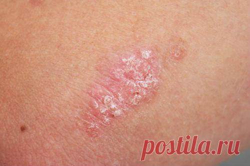 Причины возникновения псориаза на нервной почве