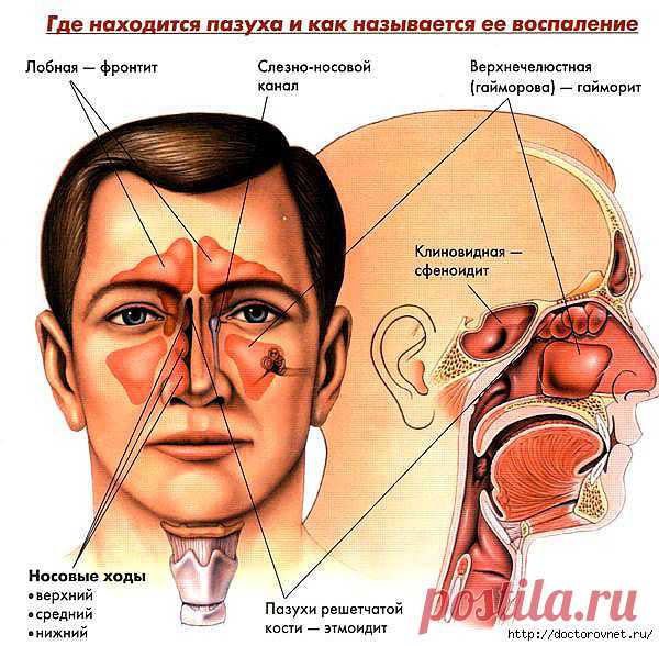 Домашнее лечение гайморита | Правила здоровья и долголетия