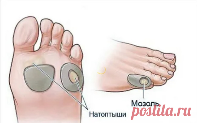 Как быстро и эффективно избавиться от натоптышей на ногах — ХОЗЯЮШКА24