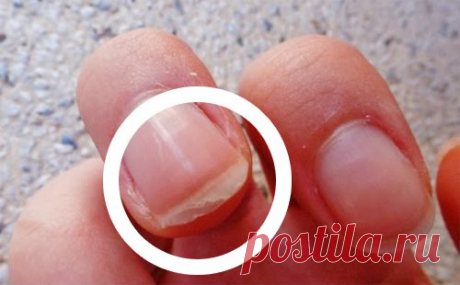 ¿Por qué se descaman las uñas? Causas, tratamientos y soluciones - Mejor Con Salud