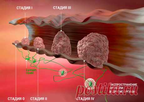 Раковые клетки погибнут, когда вы включите в рацион 5 продуктов