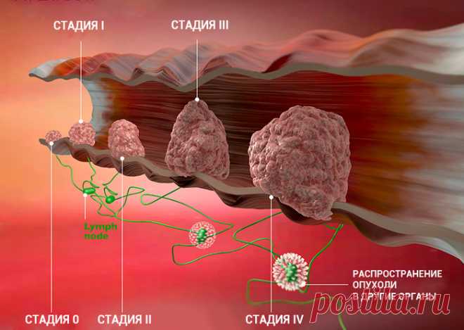 Раковые клетки погибнут, когда вы включите в рацион 5 продуктов