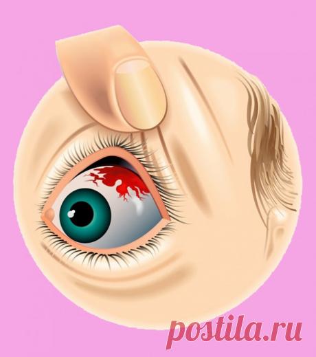 Почему в глазу лопается сосуд? Среди распространенных причин можно назвать сильный кашель, поднятие тяжестей, травму. Субконъюнктивальное кровоизлияние обычно не дает осложнений.