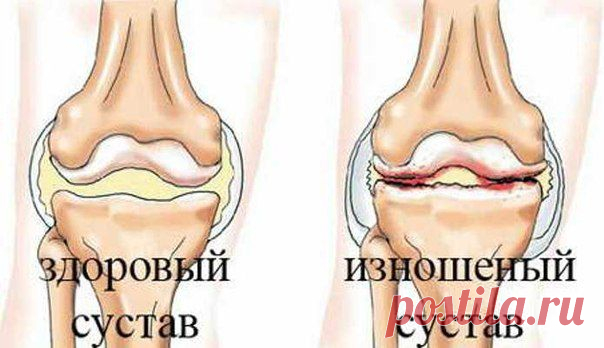 Отличный рецепт от боли в суставах | Женский журнал