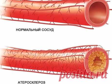 Почему возникает атеросклероз? / Будьте здоровы