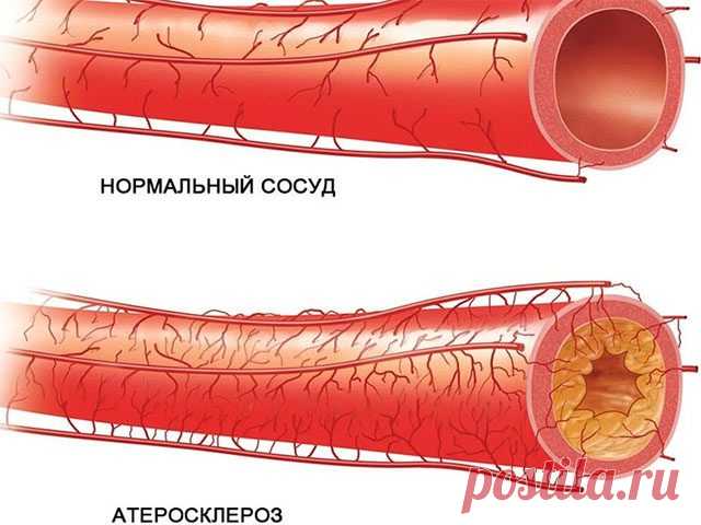 Почему возникает атеросклероз? / Будьте здоровы