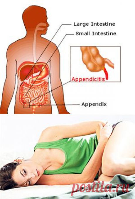 Аппендицит: симптомы и причины - Красота и здоровье - www.calorizator.ru