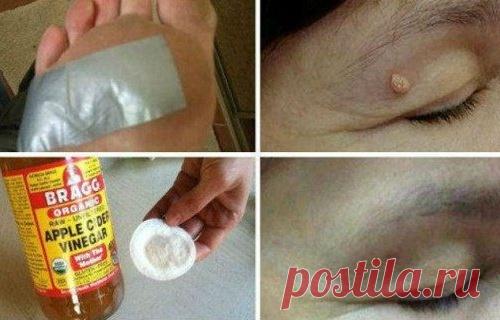 Эффективное народное средство при бородавках, папиломах, кандиломах и угрях