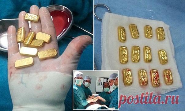 В одну из клиник Дели доставили 63-летнего мужчину с жалобами на сильные боли в животе. 
Пациент был немедленно отправлен на рентген. Тогда на снимке в желудке пациента был виден кусок металла. 
По словам проводившего операцию хирурга, 