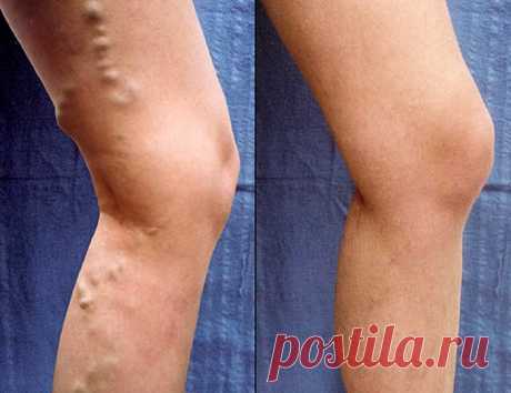 Как я избавилась от варикоза за 1 неделю!