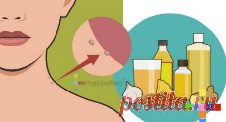 Народные средства от папиллом Папилломы порой доставляют массу неудобств. Но вы не должны с ними мириться!Папилломы — это очень распространенная проблема. Но несмотря на внешнюю непривлекательность, эти наросты безвредны. Часто он...