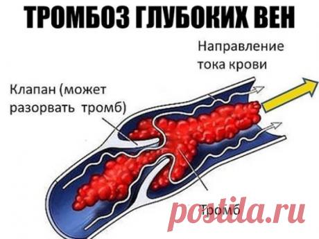 ТРОМБОЗ ГЛУБОКИХ ВЕН. 
 ПЕЛАГЕЮ ПЕТРОВНУ ВСПОМИНАЮ ДОБРЫМ СЛОВОМ С вестником «ЗОЖ» знакома еще со страничек «Здоровый образ жизни», что печатались в «Советском спорте», то есть уже лет 10. С удовольствием читаю рецепты, которые предлагают читатели, и в свою очередь хочу поделиться своими. 
 Когда мне было 28 лет, я перенесла операцию по поводу удаления камня из почки. После операции началось осложнение: появился тромбоз глубоких вен нижней конечности. 
 В 33 года меня настолько мучили боли, что