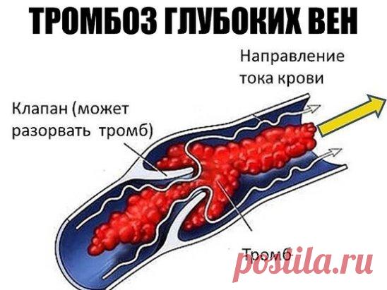 ТРОМБОЗ ГЛУБОКИХ ВЕН. 
 ПЕЛАГЕЮ ПЕТРОВНУ ВСПОМИНАЮ ДОБРЫМ СЛОВОМ С вестником «ЗОЖ» знакома еще со страничек «Здоровый образ жизни», что печатались в «Советском спорте», то есть уже лет 10. С удовольствием читаю рецепты, которые предлагают читатели, и в свою очередь хочу поделиться своими. 
 Когда мне было 28 лет, я перенесла операцию по поводу удаления камня из почки. После операции началось осложнение: появился тромбоз глубоких вен нижней конечности. 
 В 33 года меня настолько мучили боли, что