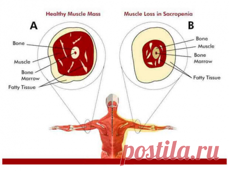Что нужно знать о саркопении-МЫШЕЧНАЯ СЛАБОСТЬ