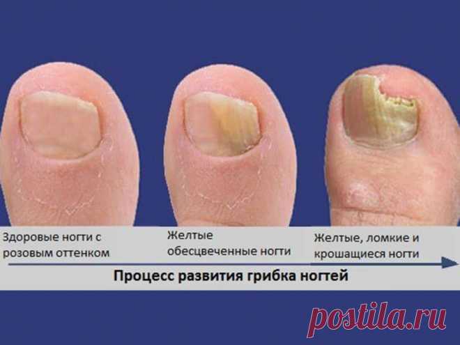 Как быстро размягчить ногти на ногах у пожилых людей в домашних условиях с грибком и без