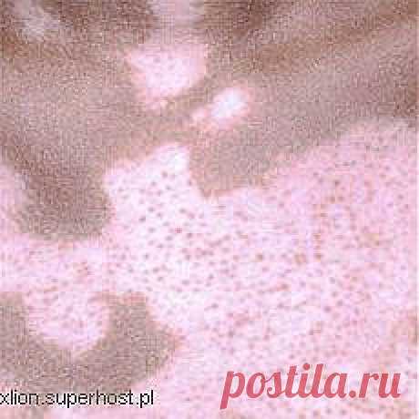 ВИТИЛИГО (ПЕСЬ, ЛЕЙКОПАТИЯ). НАРОДНЫЕ МЕТОДЫ ЛЕЧЕНИЯ ВИТИЛИГО