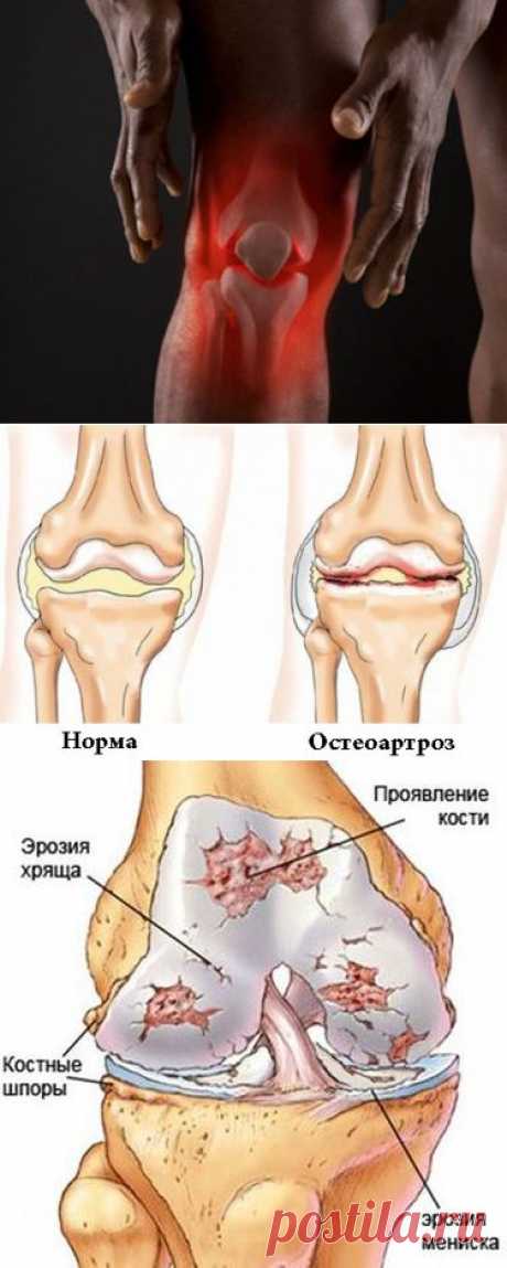 Характеристика остеоартроза коленного сустава: причины, симптомы, лечение | Познавательный сайт ,,1000 мелочей&quot;