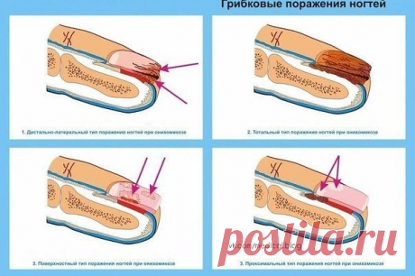 КАК ВЫЛЕЧИТЬ ГРИБОК НА НОГТЯХ

Ногтевой грибок является не только неприятным, но и опасным в случае запущенной формы заболеванием, лечить которое необходимо заметив первые симптомы. Как правило, лекарства, предлагаемые медиками, несут серьёзную нагрузку на печень или же (в случае мазей) не приносят желаемого эффекта. Прочитав эту статью, вы научитесь лечить этот недуг при помощи натуральных домашних рецептов, которые были собраны на просторах сети.

Эффективные средства дл...