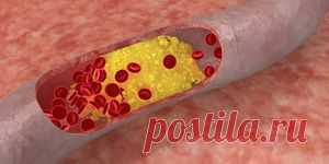 Атеросклероз церебральных артерий : Профилактика : Здоровье : Subscribe.Ru