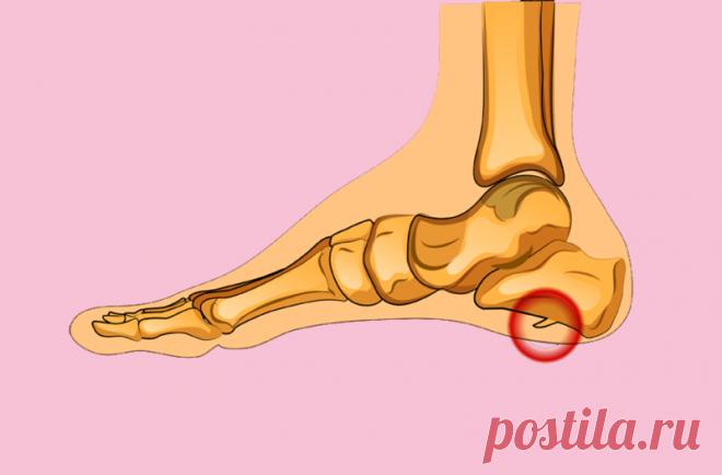 Какой должна быть обувь и как не заработать пяточную шпору? Хождение босиком в некоторых случаях может иметь негативные последствия для здоровья. Например, пол из бетона / плитки увеличивает вероятность развития так называемой пяточной шпоры. Важную роль играет обувь, в которой вы ходите дома и на улице. Как не допустить возникновения пяточной шпоры?