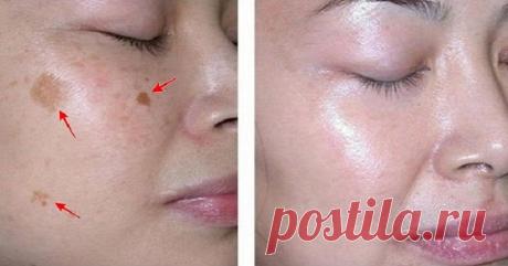 Это удалит пятна с вашего лица всего за 3 ночи!