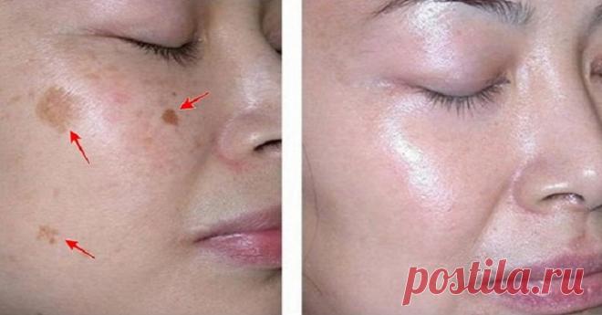 Это удалит пятна с вашего лица всего за 3 ночи!