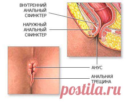 Анальная трещина