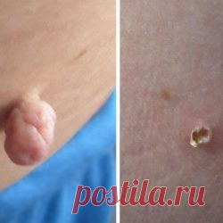 5 способов избавления от папиллом в домашних условиях: что-то вам точно поможет (советы по применению) | Golbis