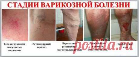 ВАРИКОЗ:   ПРИЧИНЫ,СИМПТОМЫ,ЛЕЧЕНИЕ.