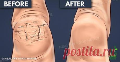 Бабушка рассказала мне об этом секрете. Он исцелил мои потрескавшиеся пятки всего за несколько дней - Журнал для женщин