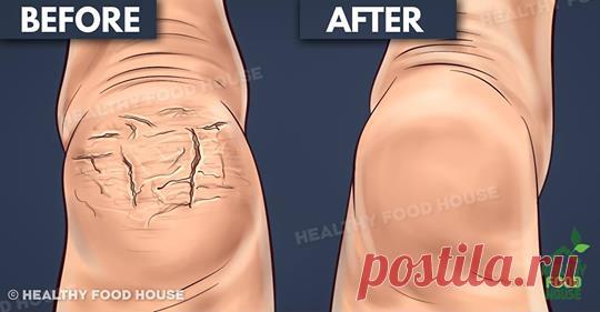 Бабушка рассказала мне об этом секрете. Он исцелил мои потрескавшиеся пятки всего за несколько дней - Журнал для женщин